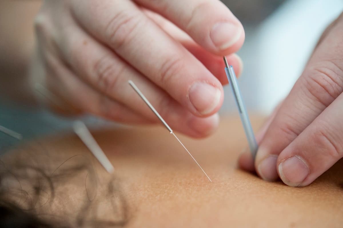 A practitioner inserting a thin needle into a client's back