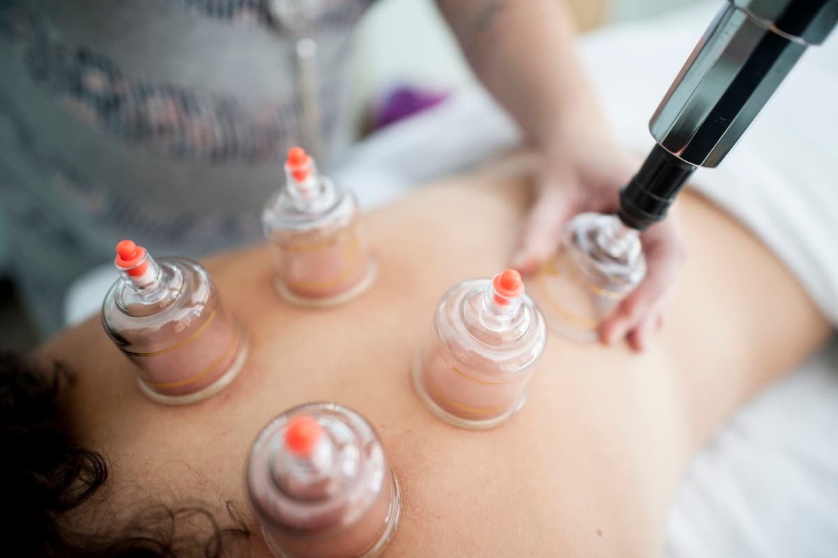 Several suction cups placed on a client's back during a cupping therapy session